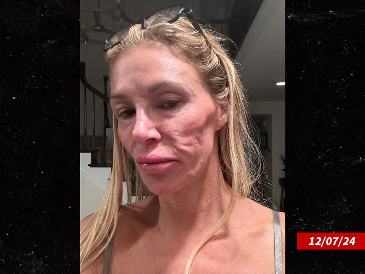 brandi glanville dissolved face fillers x