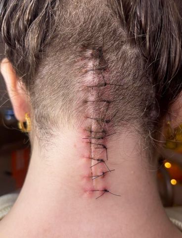 Daniele Gray after surgery Daniele Gray