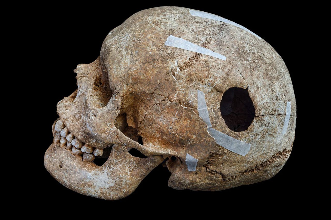 A skull with a large hole discovered by University of Cambridge archaeologists and studentsCredit: Cambridge Archaeological