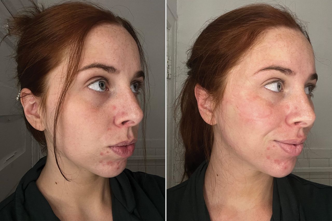 person showing results on using popular face mask medicube People