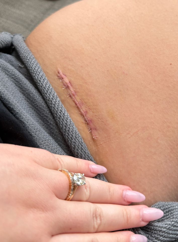 Jordan Downing's scarCredit: Jordan Downing