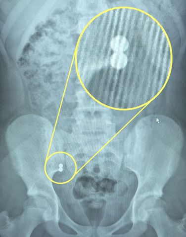 A mum claims her schoolgirl daughter was forced to undergo life-saving surgery after an Amazon magnet fidget toy she swallowed tore through TWO organs. The magnets traveled through Bella's digestive systemCredit: Kennedy News and Media