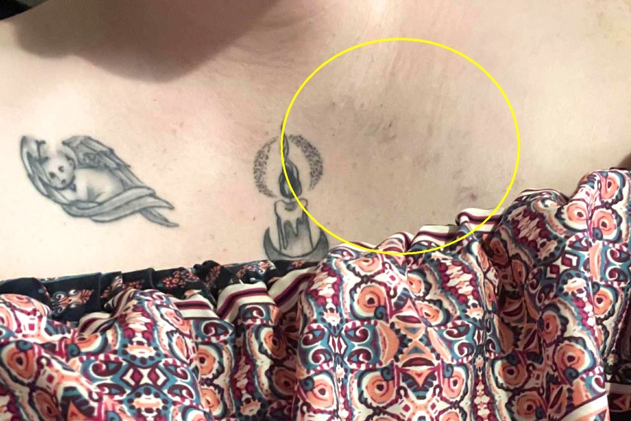 (Pictured: ZOE MCGROARTY, 32, SHOWING THE DVT IN HER ARM.) A new mum claims doctors 'fobbed off' her agony as 'strain' from holding her BABY - only to discover it was actually deadly blood clots. Zoe McGroarty gave birth to little Daisy McGroarty, from a town near Bath, on April 13th, 2023, who weighed in at 7 lbs 11oz. Two days after haemorrhaging in the delivery room, the mum-of-two said she began to feel an 'icy blast' radiating through her body. Zoe McGroarty's body amid her health struggles.Credit: Kennedy News & Media