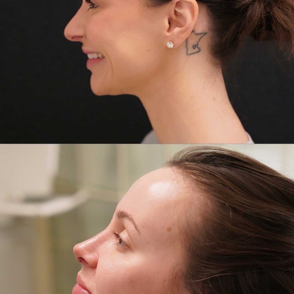 Catherine Ebs after her first rhinoplasty; Catherine Ebs after her revision rhinoplasty.Credit: Courtesy of Catherine Ebs