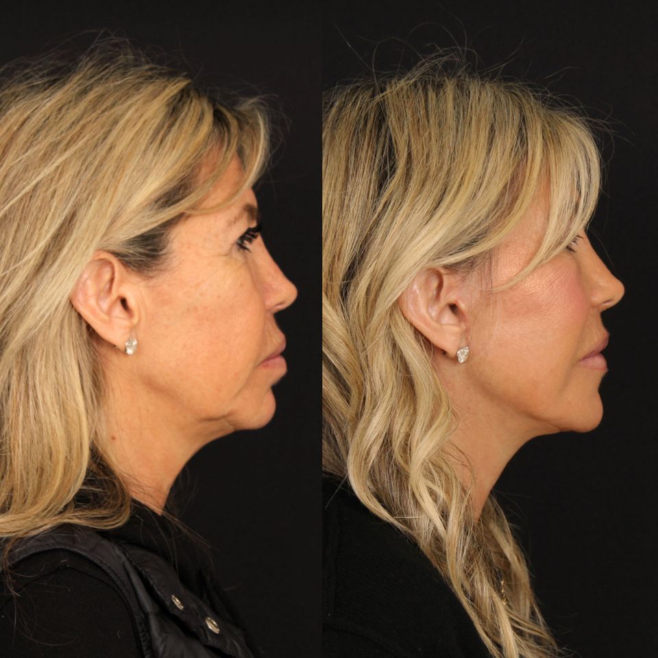Amy Kaplan before surgery (left) and after (right)Credit: Davis Facial Plastics