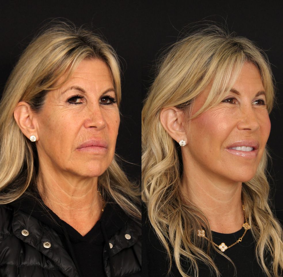 Amy Kaplan before surgery (left) and after (right)Credit: Davis Facial Plastics