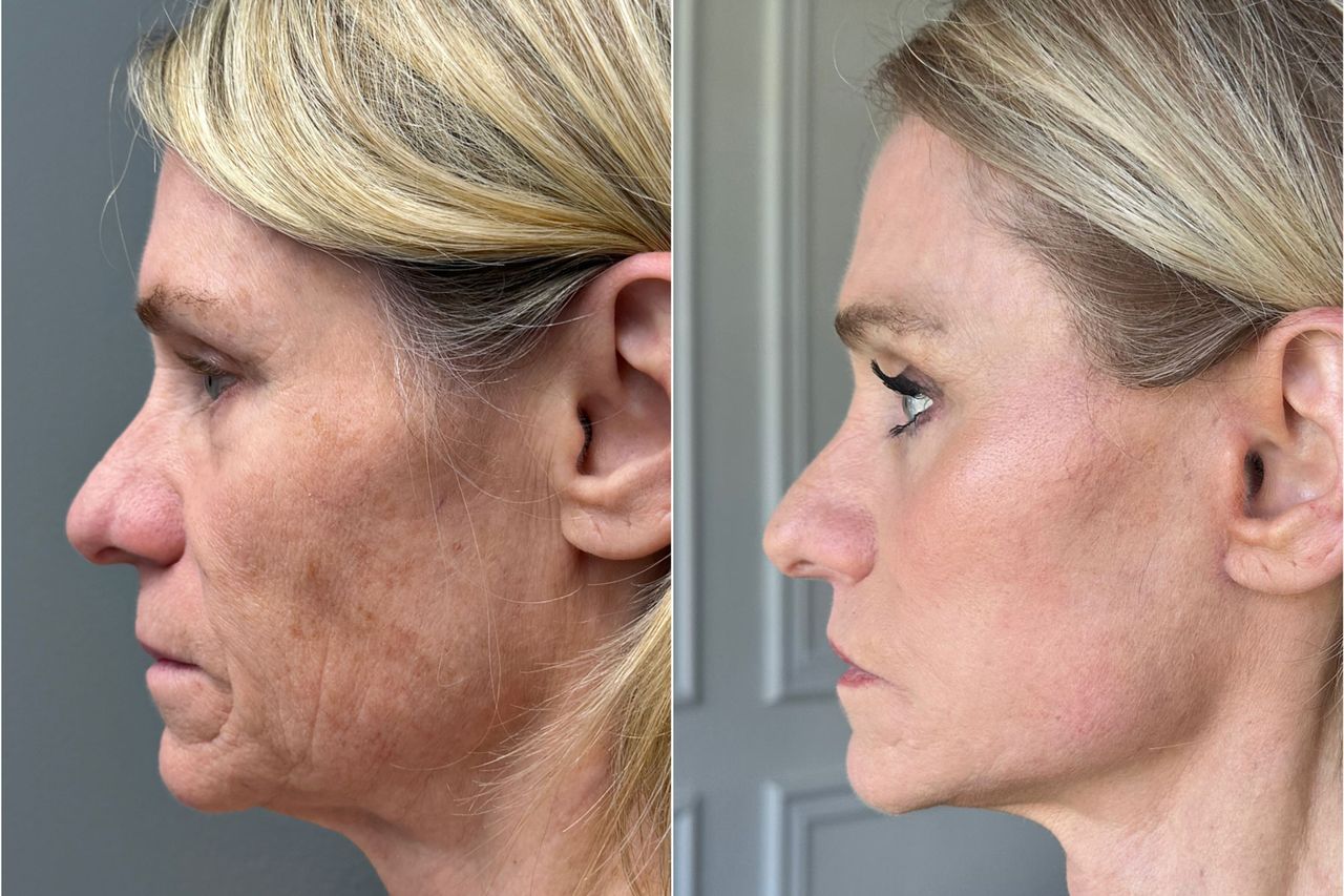 A side profile of Denise before and after plastic surgeryCredit: Truesdale Facial Plastic Surgery