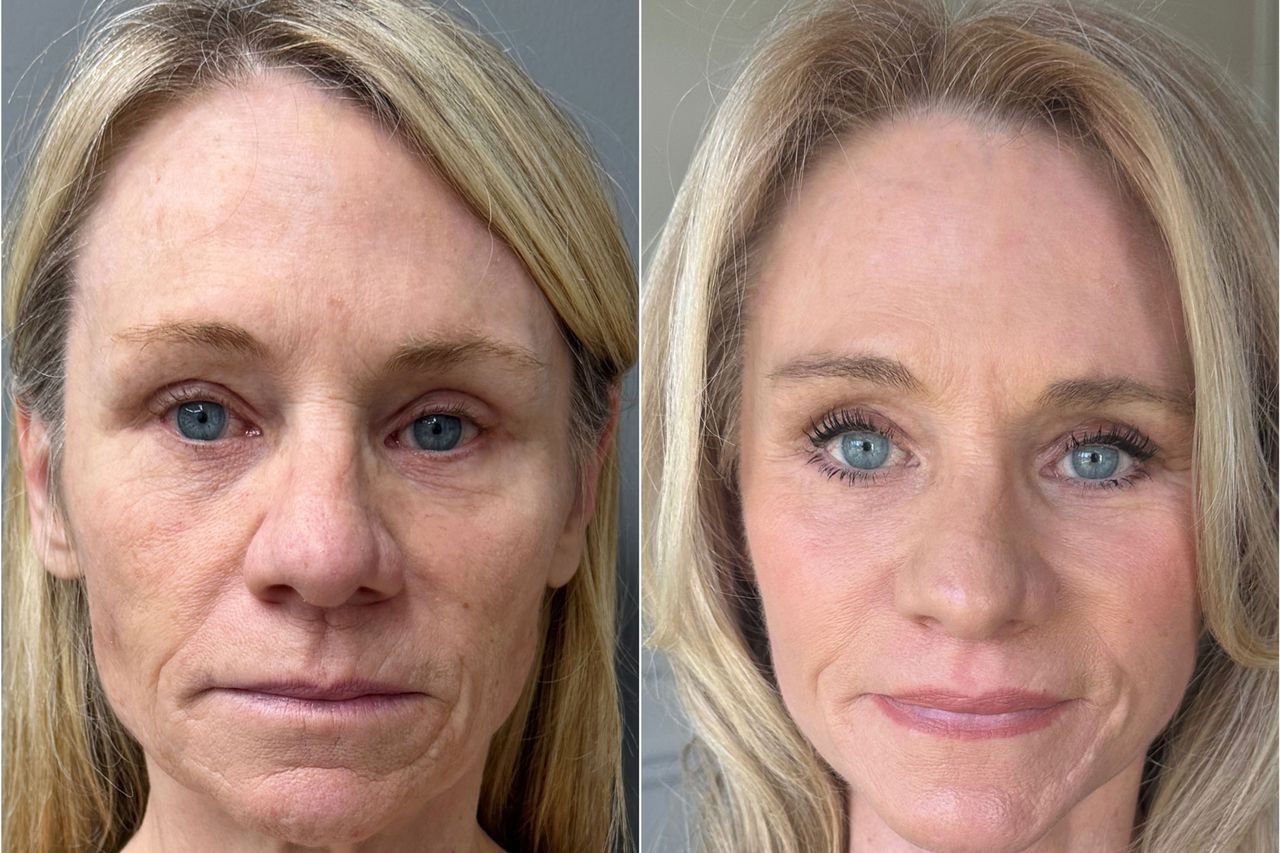 Denise before and after her facial rejuvenationCredit: Truesdale Facial Plastic Surgery