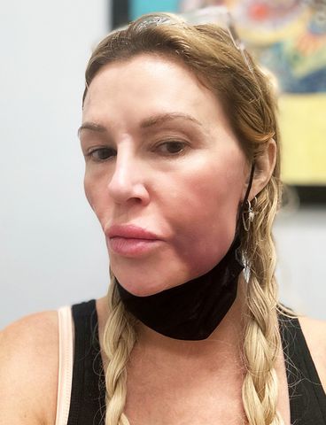 Brandi Glanville shares photos of Facial Disfigurement. Brandi Glanville shares photo of her facial disfigurementCredit: Brandi Glanville/X