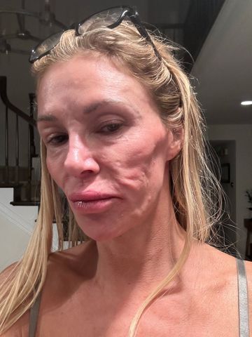 Brandi Glanville. Brandi Glanville shares photo of her facial disfigurementCredit: Brandi Glanville/X