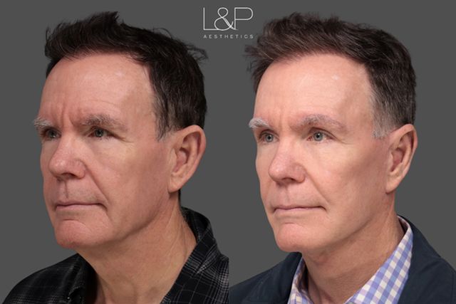 Charles before plastic surgery (left) and after (right)Credit: L&P Aesthetics