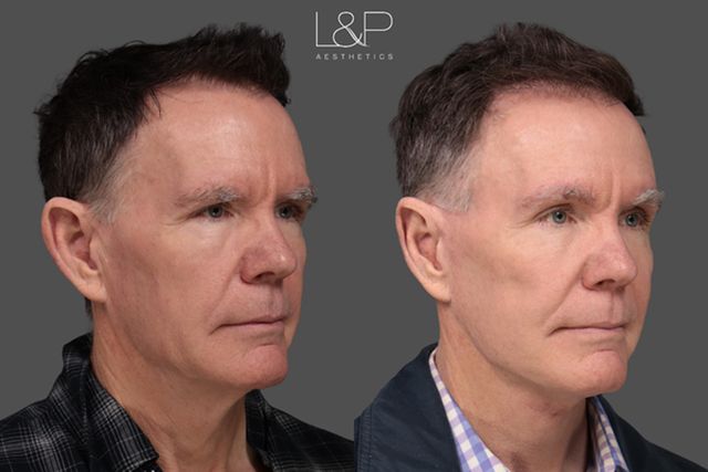 Charles before plastic surgery (left) and after (right)Credit: L&P Aesthetics