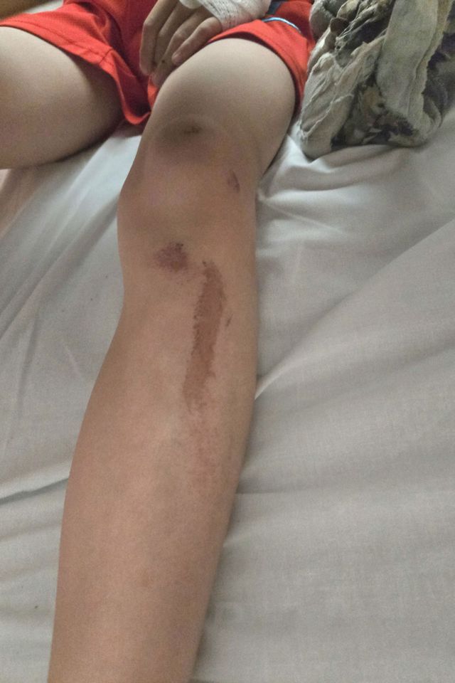 LEWIS COPE, 10, LUCKILY ONLY SUFFERED WITH CUTS AND BRUISES AFTER COLLIDING INTO A CAR WHILE RIDING HIS BIKE) A 10-year-old is lucky to be alive after he ploughed his bike into a moving car - that he didn't hear approach as he was blasting out music. Rich Cope, from Chesterfield, Derbyshire, rushed out the house on June 24 Bruises on his legCredit: Kennedy News and Media