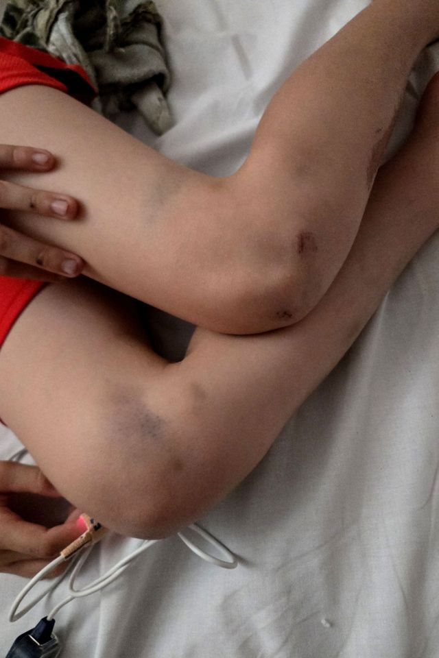 LEWIS COPE, 10, LUCKILY ONLY SUFFERED WITH CUTS AND BRUISES AFTER COLLIDING INTO A CAR WHILE RIDING HIS BIKE) A 10-year-old is lucky to be alive after he ploughed his bike into a moving car - that he didn't hear approach as he was blasting out music. Rich Cope, from Chesterfield, Derbyshire, rushed out the house on June 24 Lewis Cope’s leg injuriesCredit: Kennedy News and Media