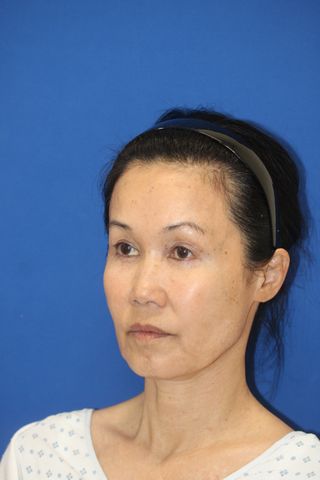 She ‘Never Thought’ She’d Be So ‘Bold’ to Get a Facelift. Then She Turned 60 Jamie before plastic surgeryCredit: Courtesy of Dr. Amir Karam