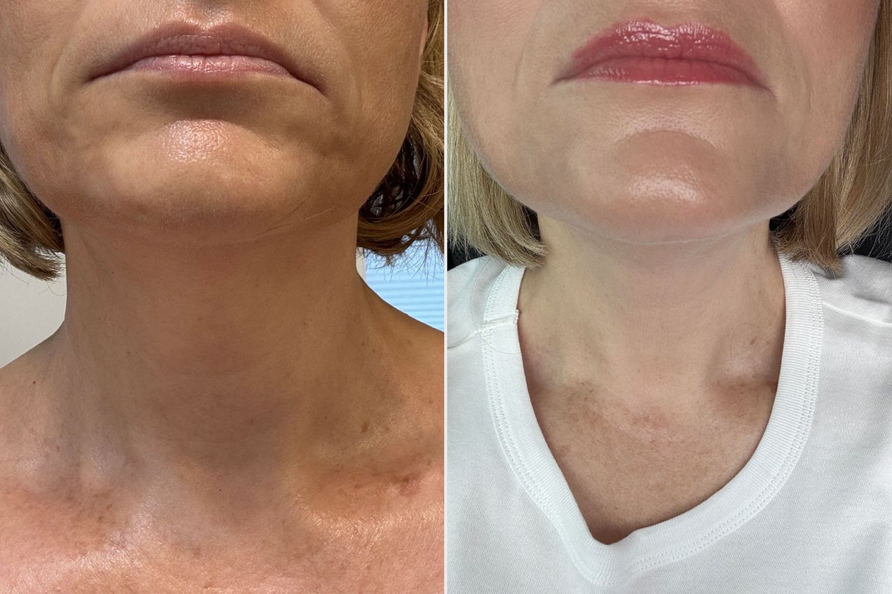 Sidebyside comparison showing a persons chin and neck area before and after applying a firming cream Before (left) and after (right).Credit: People