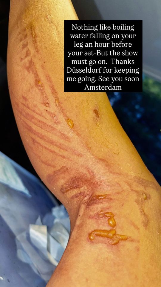 Nicole Scherzinger shares photo of burns on her legCredit: Nicole Scherzinger/Instagram